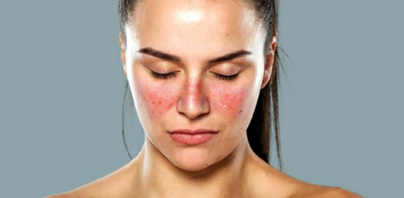 Lupus Self Test: Do I Have Lupus? - ProProfs Quiz